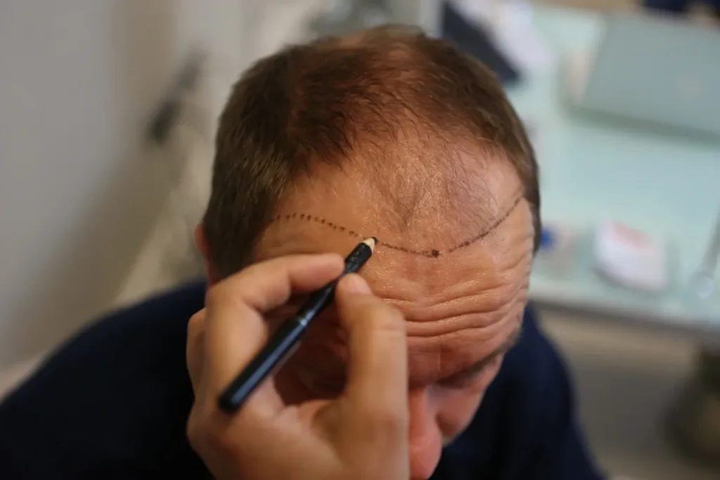 Extraction of body hair grafts for scalp transplantation