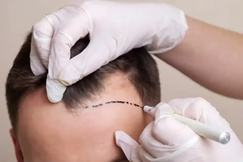 A skilled surgeon extracts grafts during a hair transplant