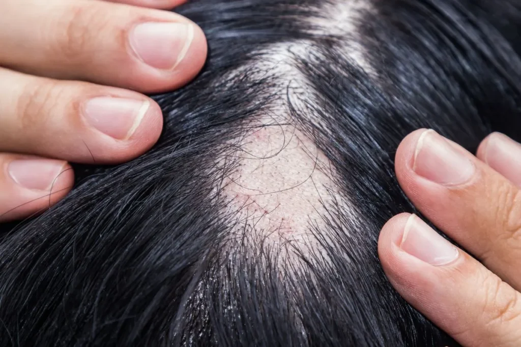 Hair Bulb vs Follicle: Key Differences for Restoration