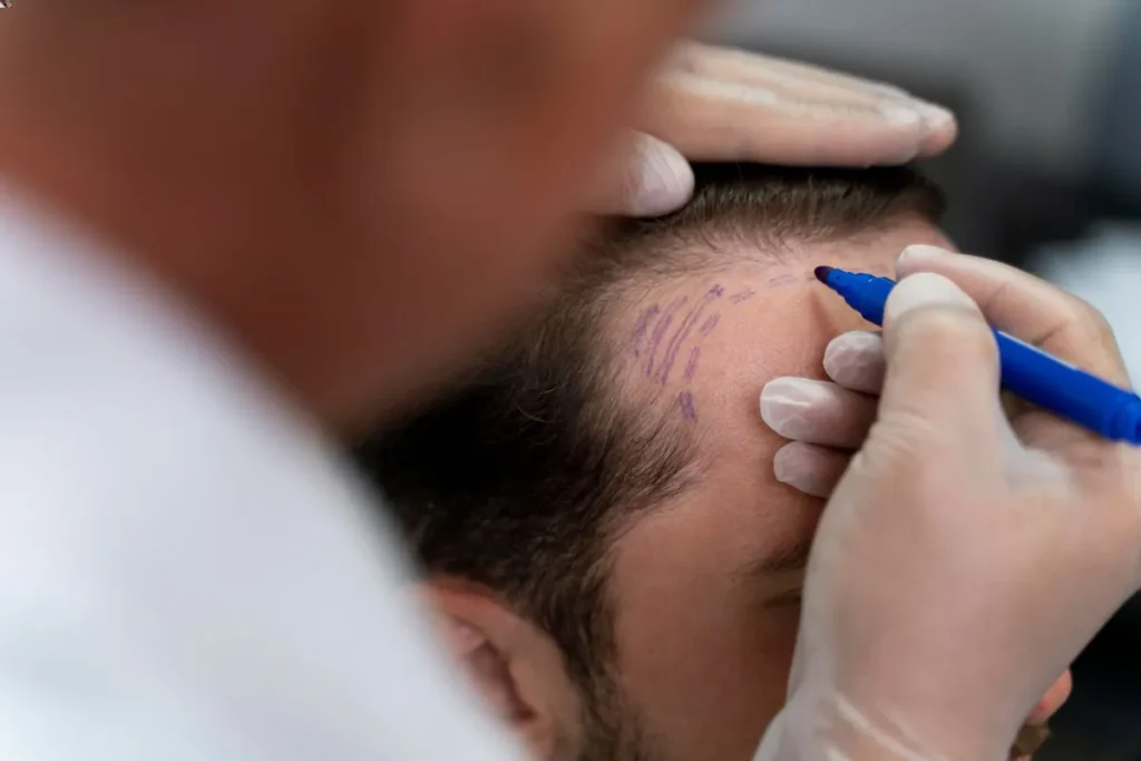 Typical hair transplant recovery timeline