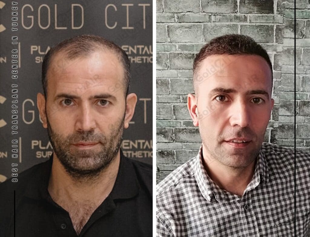 The Science Behind Hair Loss Mechanisms