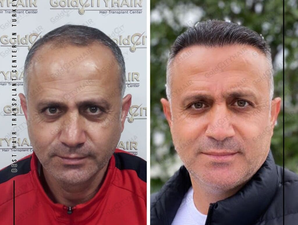 Finasteride Chemical Properties and Structural Composition