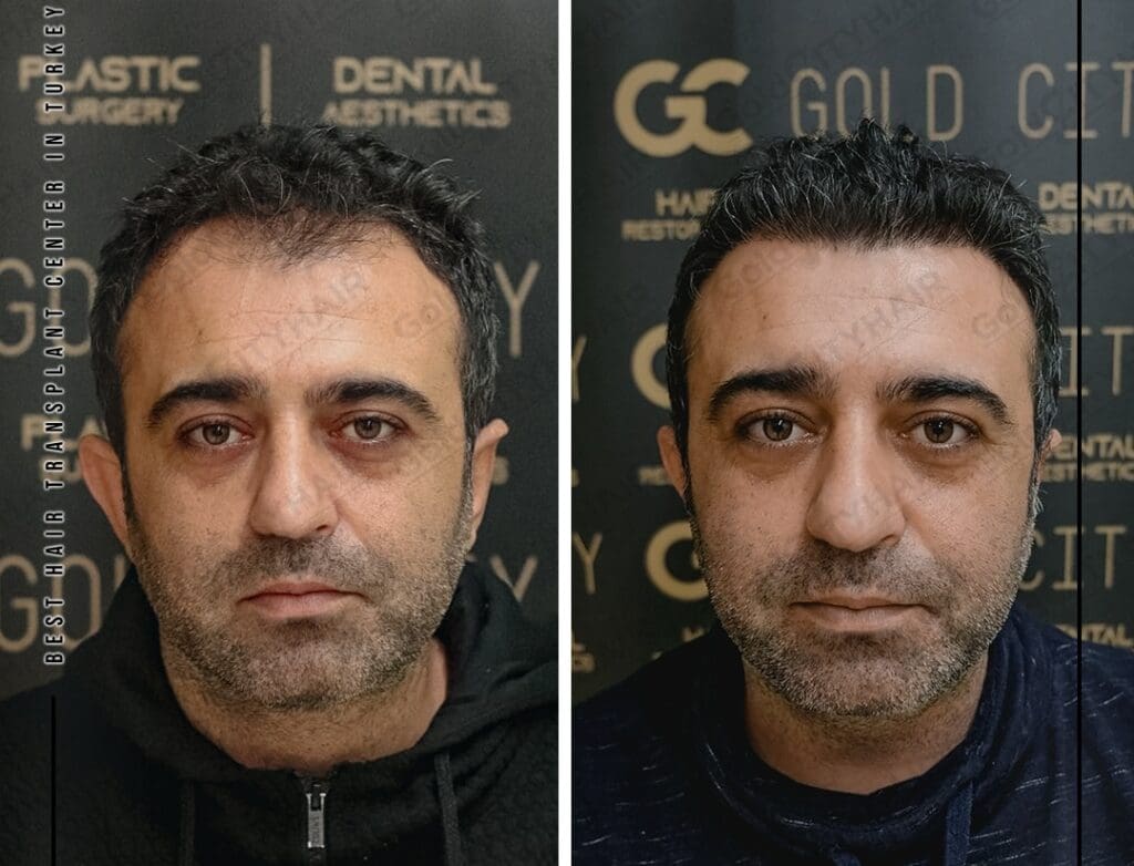 How to Make Thin Hair Thicker 5 Proven Methods