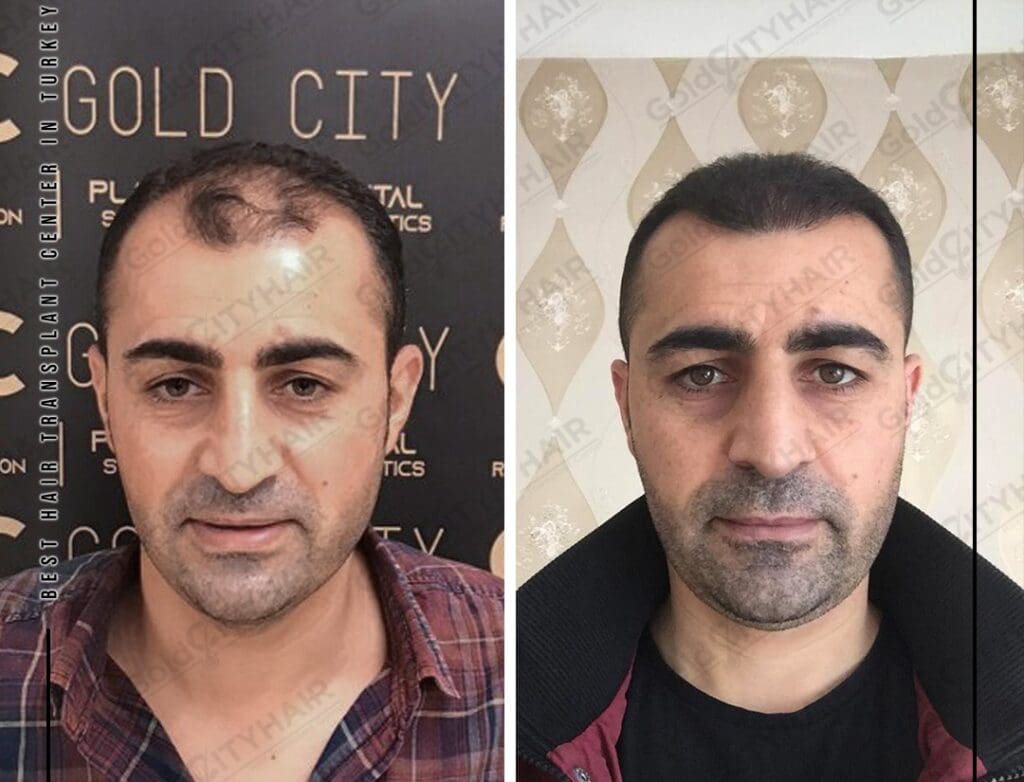 Understanding Scalp Tenderness: Prevalence and Symptoms