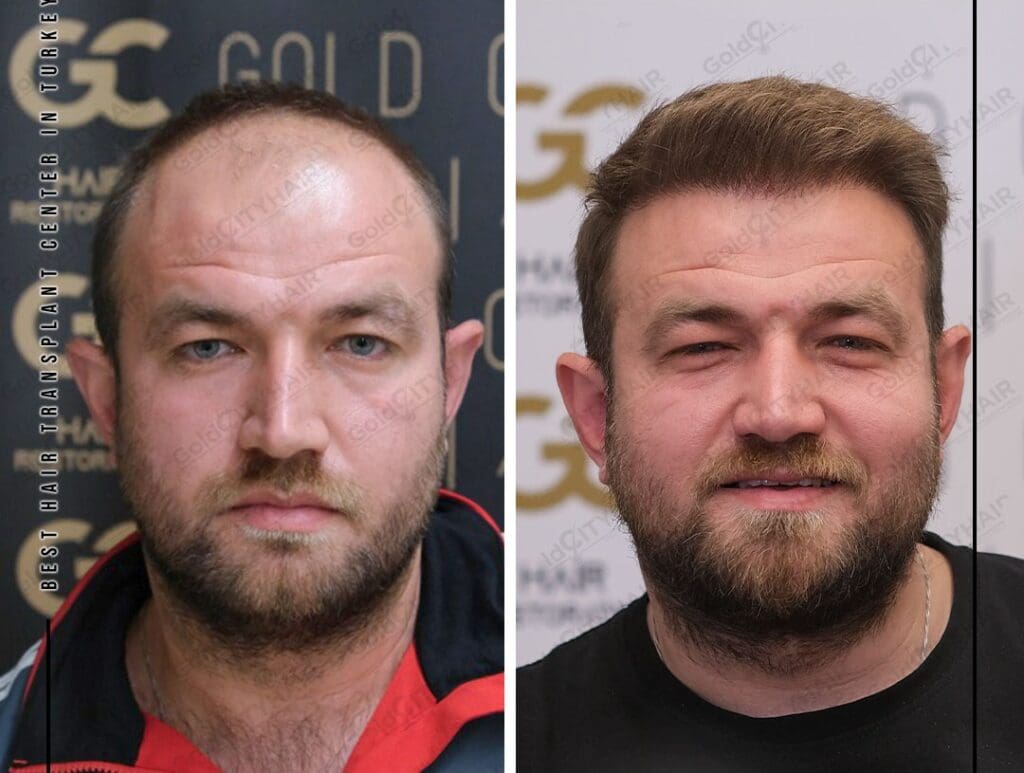 Does High Blood Pressure Cause Hair Loss? Research Evidence