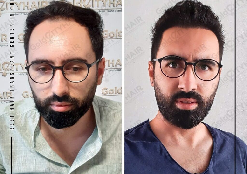 The Science Behind Depression and Hair Loss