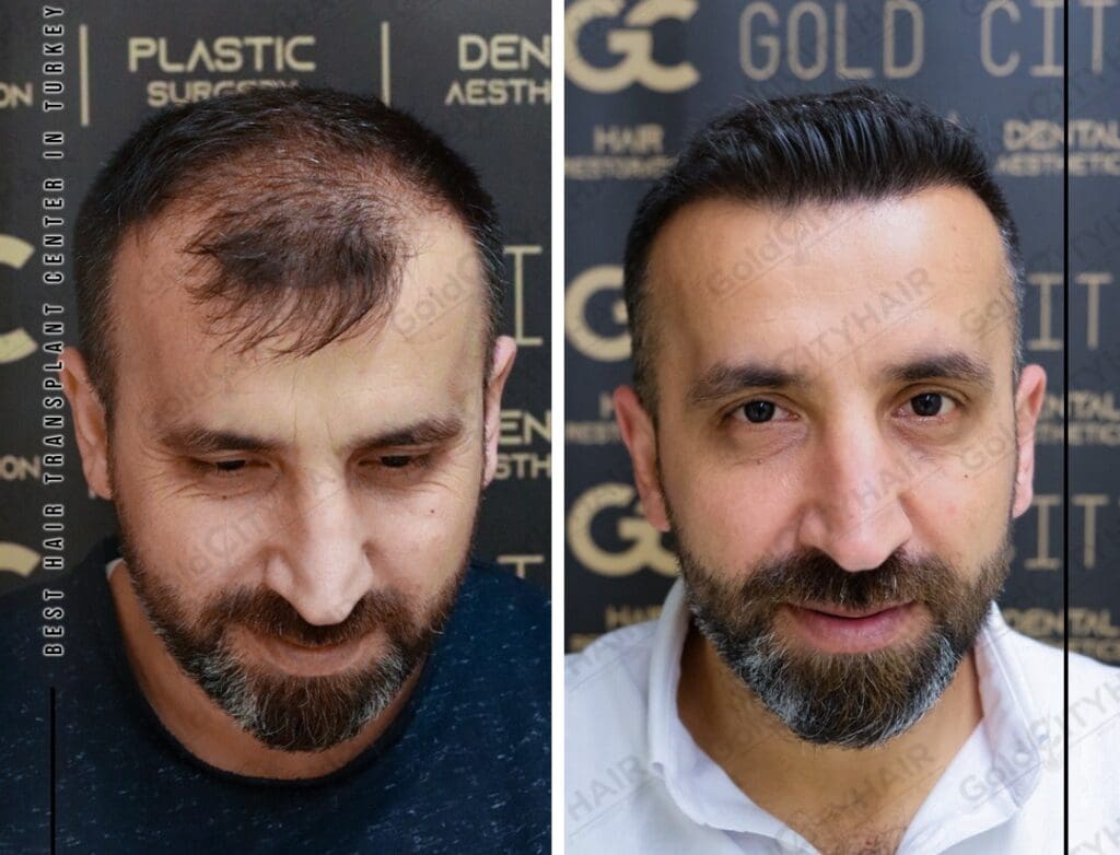 How to Grow Hair in a Week Tips for Faster Growth