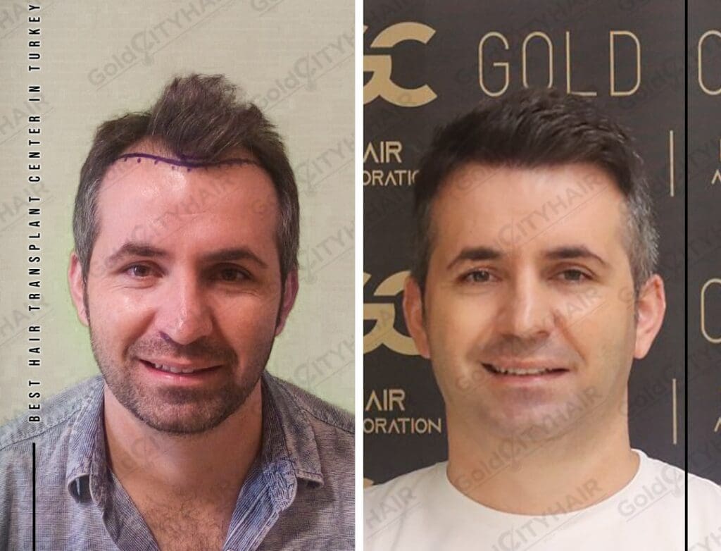 How to Treat Trichomycosis Complete Guide