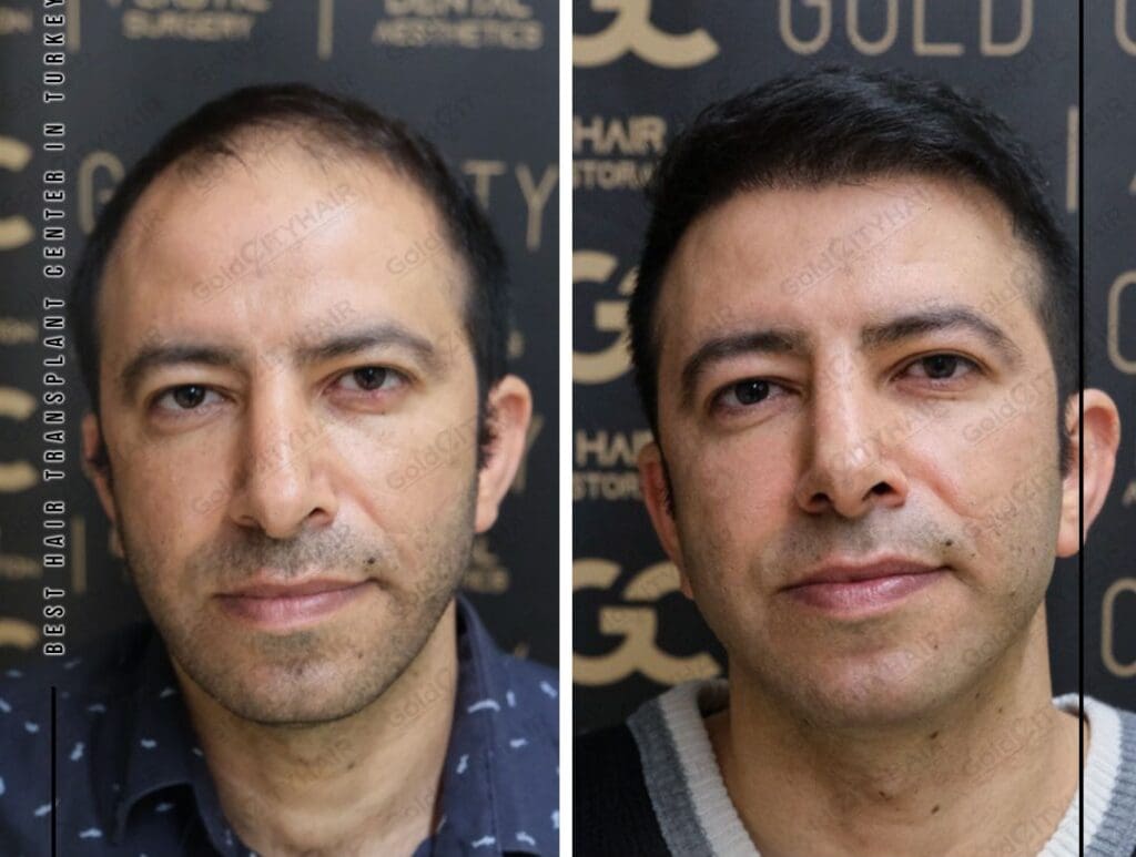 Understanding Scalp Eczema vs Psoriasis