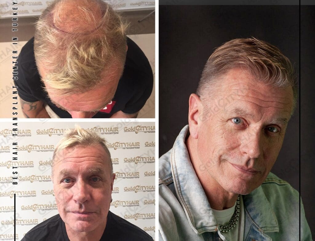 Can COVID Cause Hair Loss? The Research Evidence