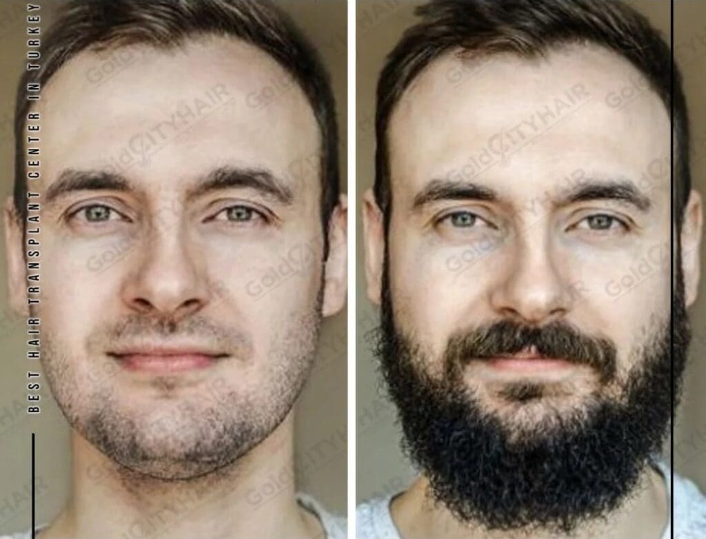 How Stress Affects Your Hair Follicles