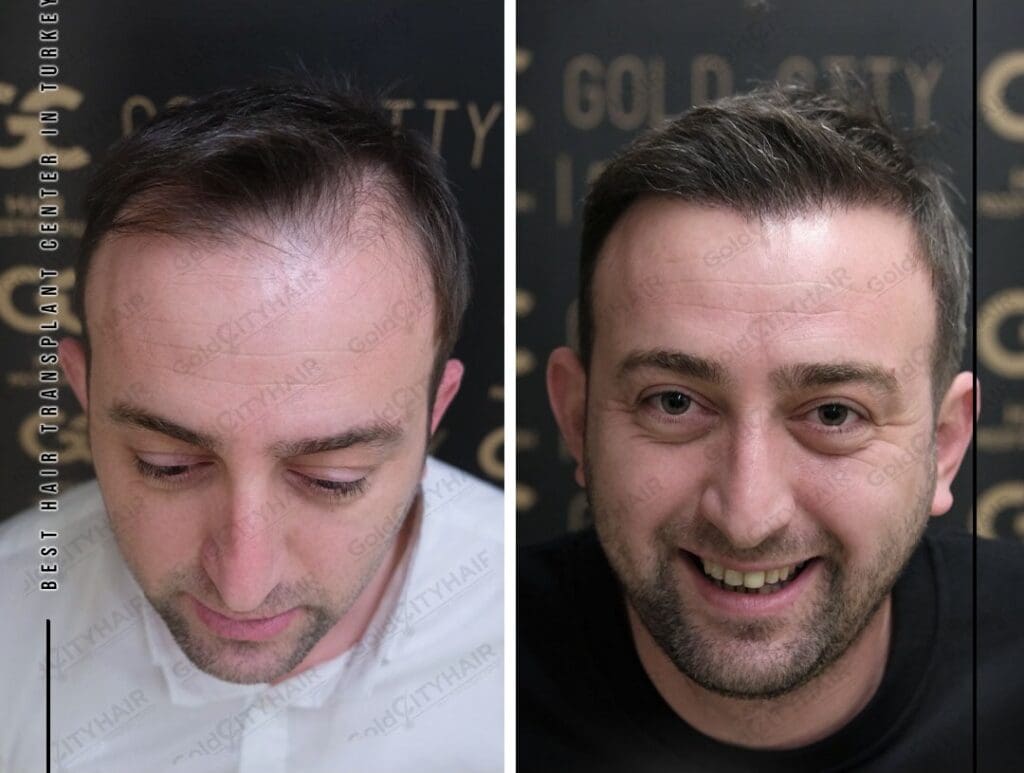Understanding Finasteride for Hair Lossaa