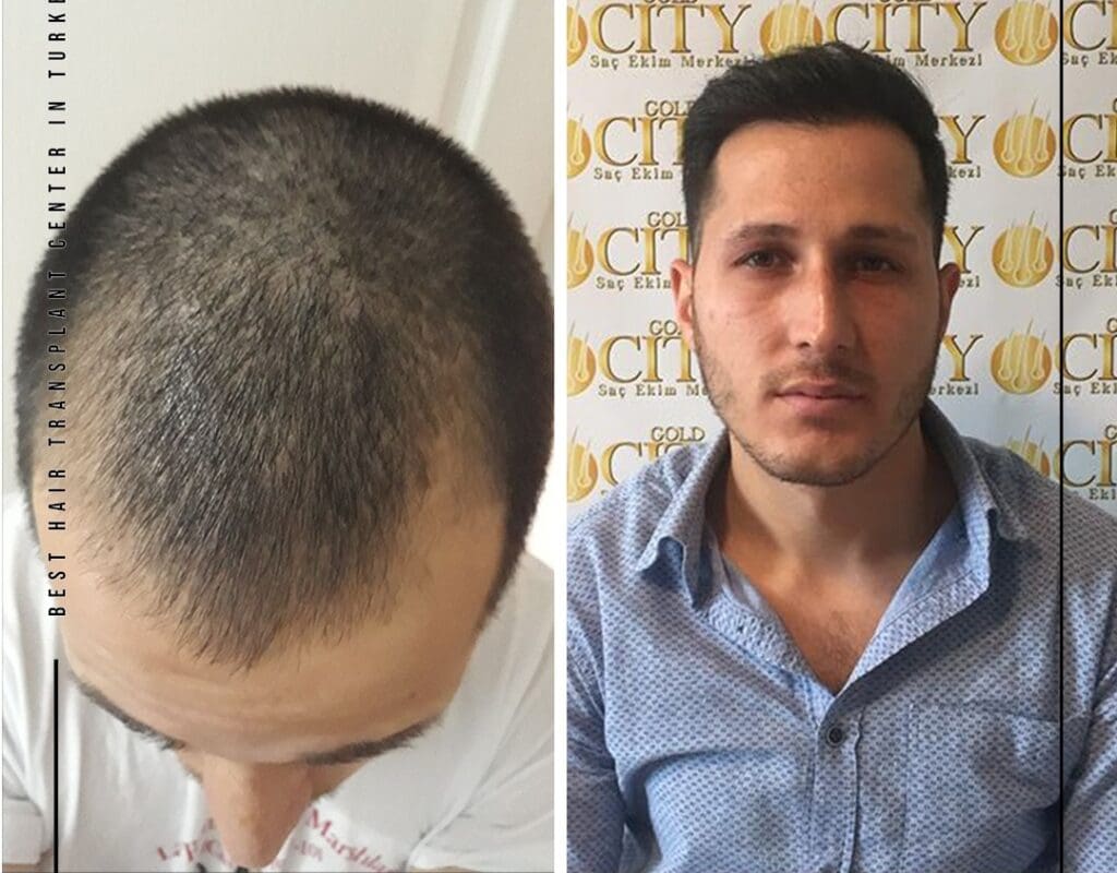 The Truth About Hair Eating Bacteria