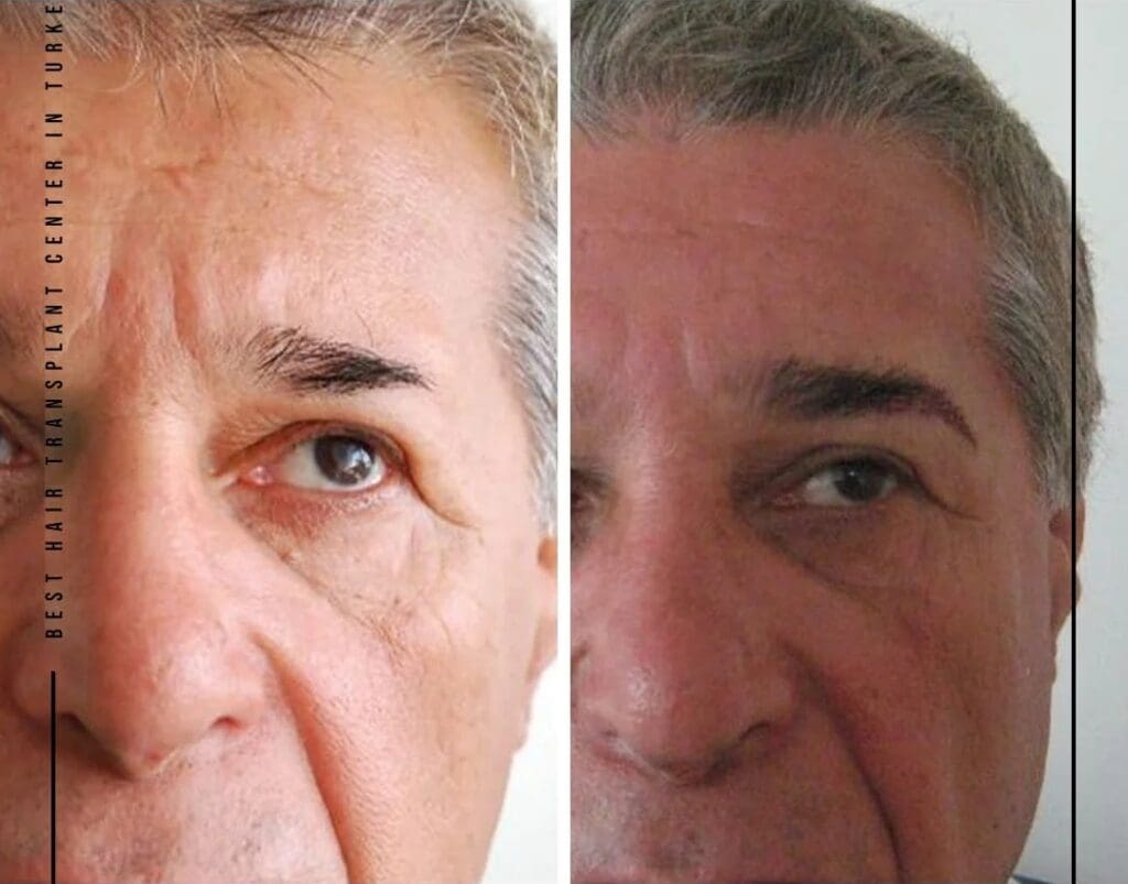 Whats the Difference Between Scalp Eczema and Psoriasis