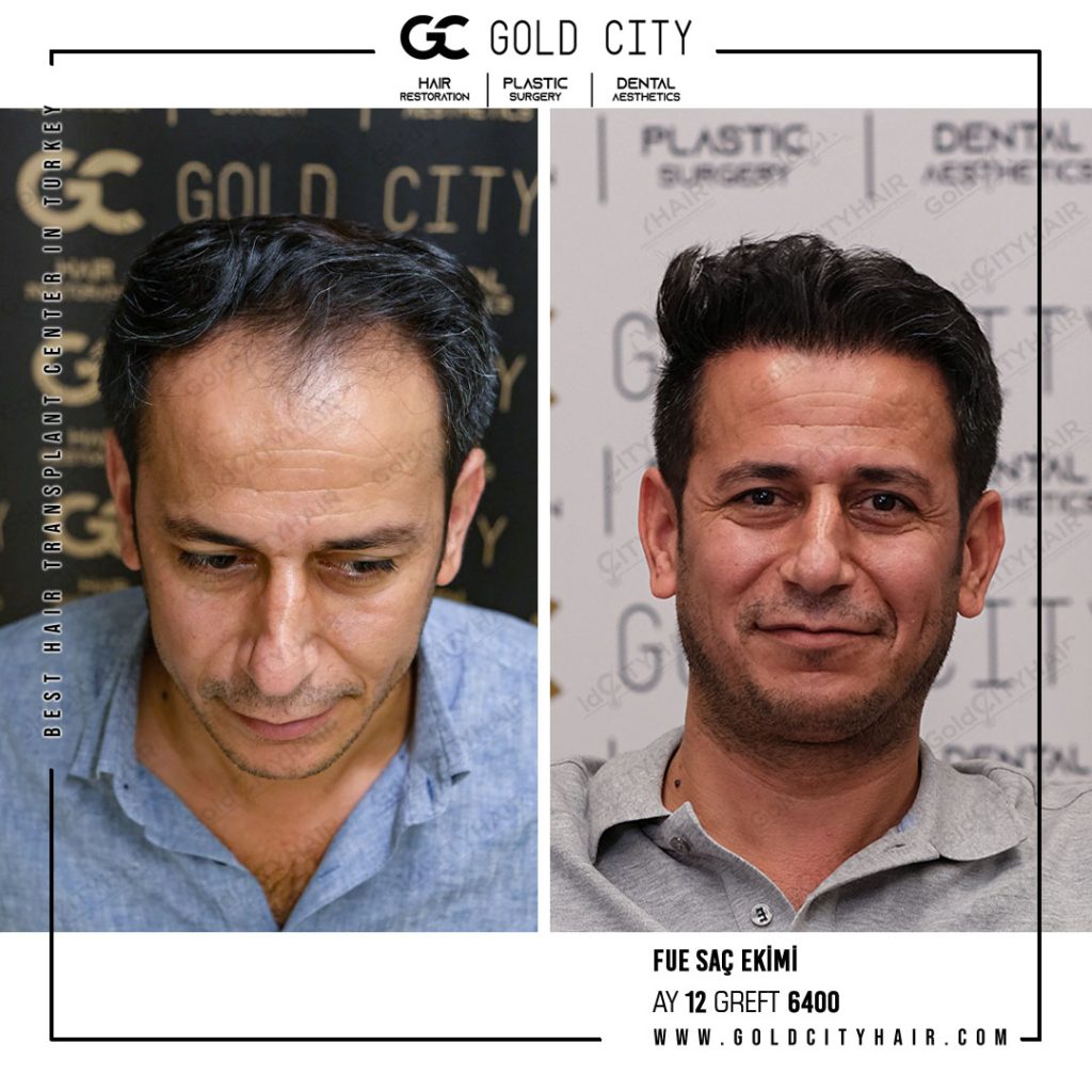 Gold City Best Hair Transplant Turkey – Best Hair Transplant Turkey