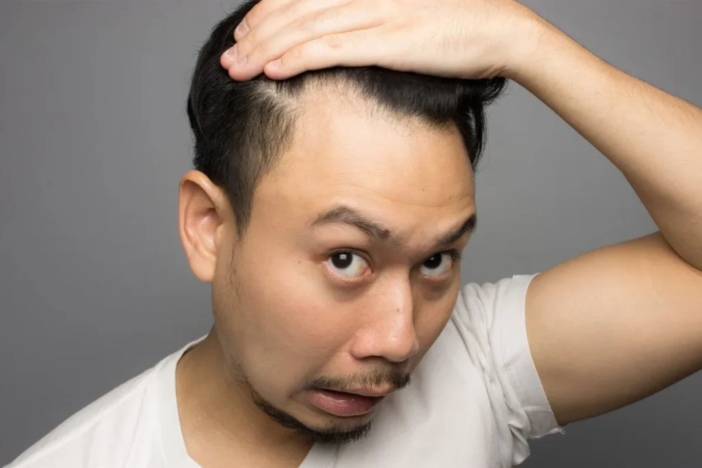 Typical donor region used in hair transplantation