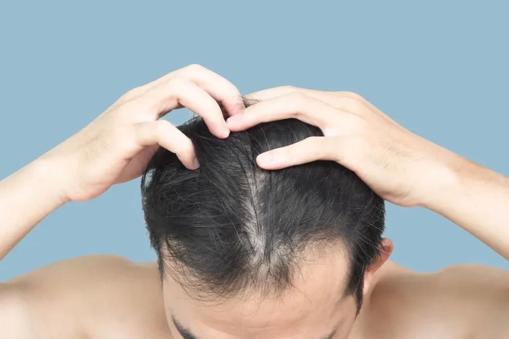 How hormones affect hair follicles
