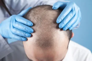 Hydration and nutrition support instant reduction of hair fall