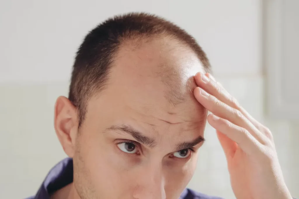 When Do Men Typically Start Going Bald? | Gold City Hair