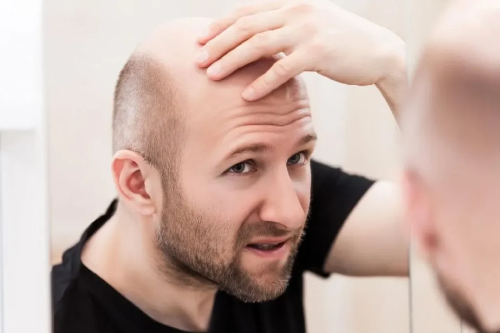Common patterns of hair loss