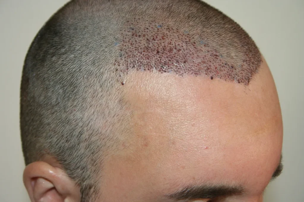 How Many Grafts Do I Need for a Successful Hair Transplant