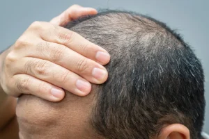 Autoimmune Hair Loss: Causes, Diagnosis & Treatment