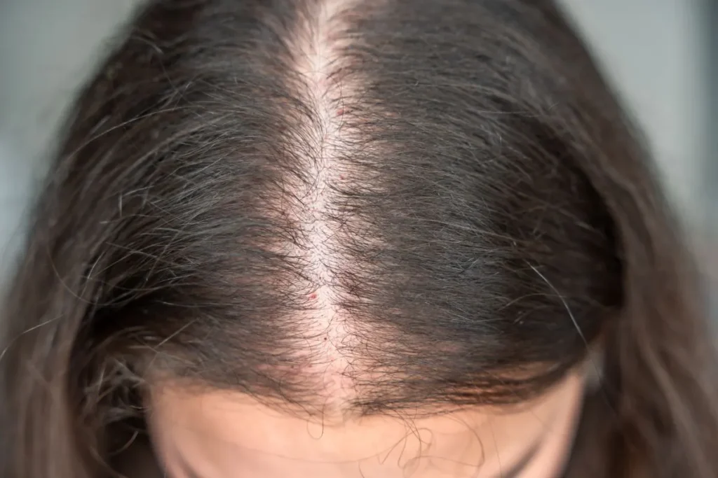 Anatomy of a hair follicle highlighting the white bulb