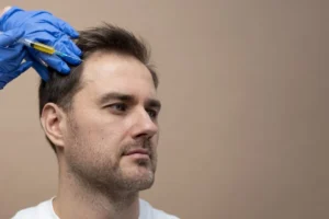 Typical scalp appearance one month after a hair transplant