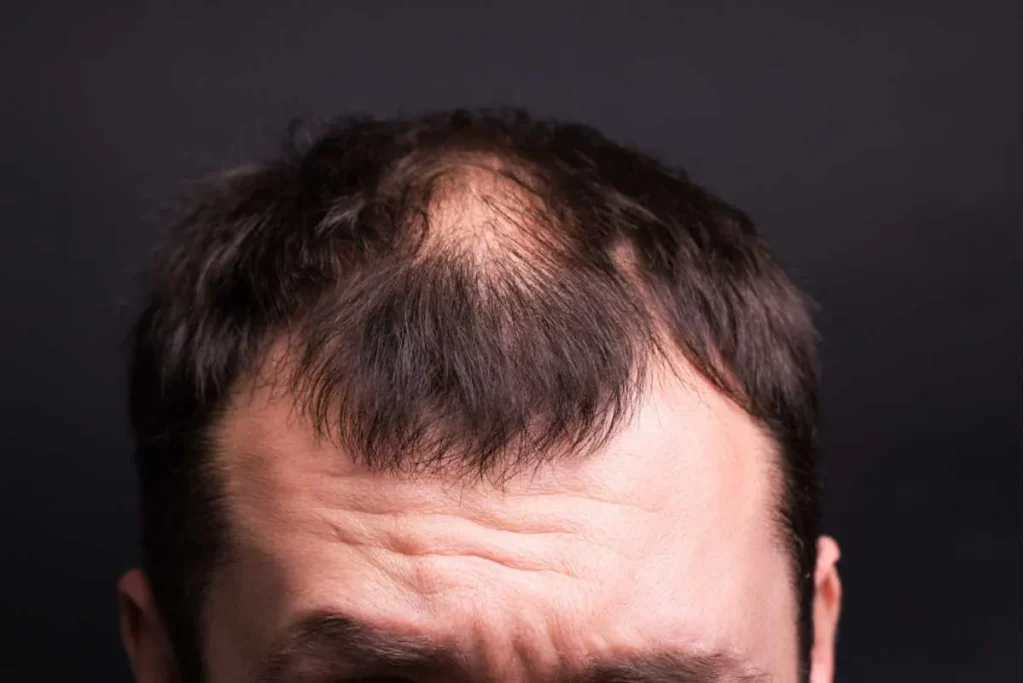 DHT‑induced follicular miniaturization