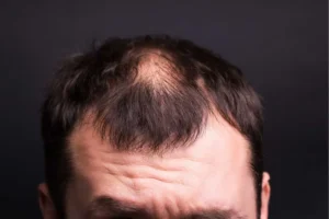 DHT‑induced follicular miniaturization