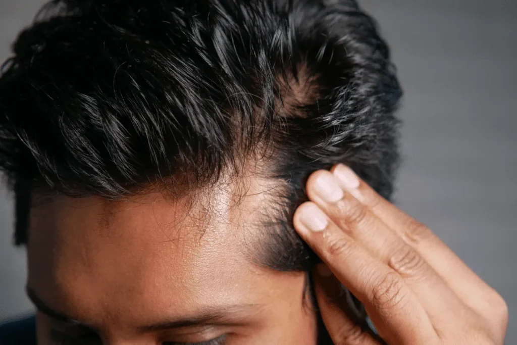Common causes of a receding hairline
