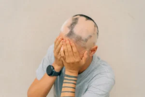 Natural Ways to Help Alopecia Effectively | Gold City Hair