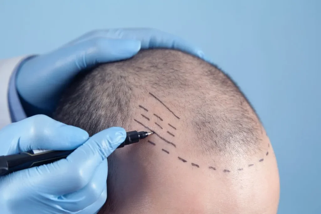 A skilled surgeon performing a FUE hair transplant