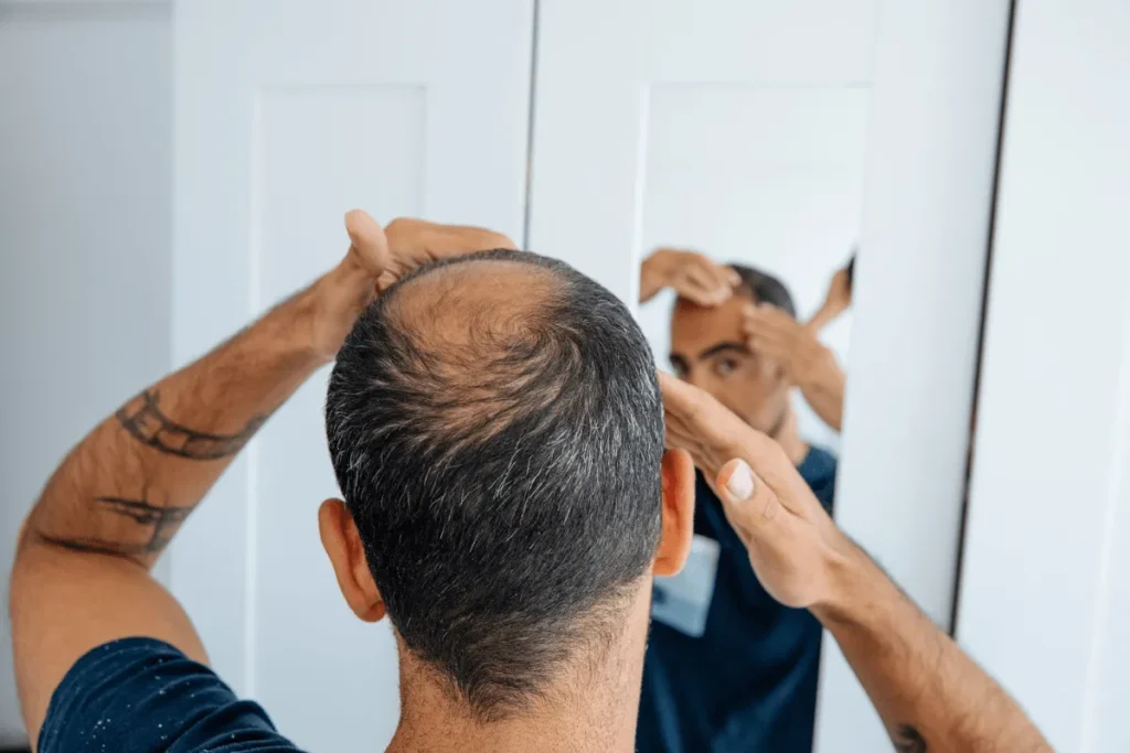 Common hair loss patterns illustrated