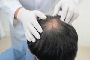 How Women Can Regrow Hair on the Crown | Gold City Hair