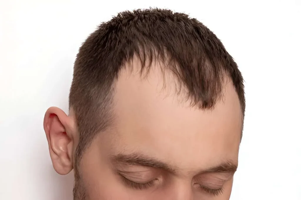 Visual guide to common hair baldness types
