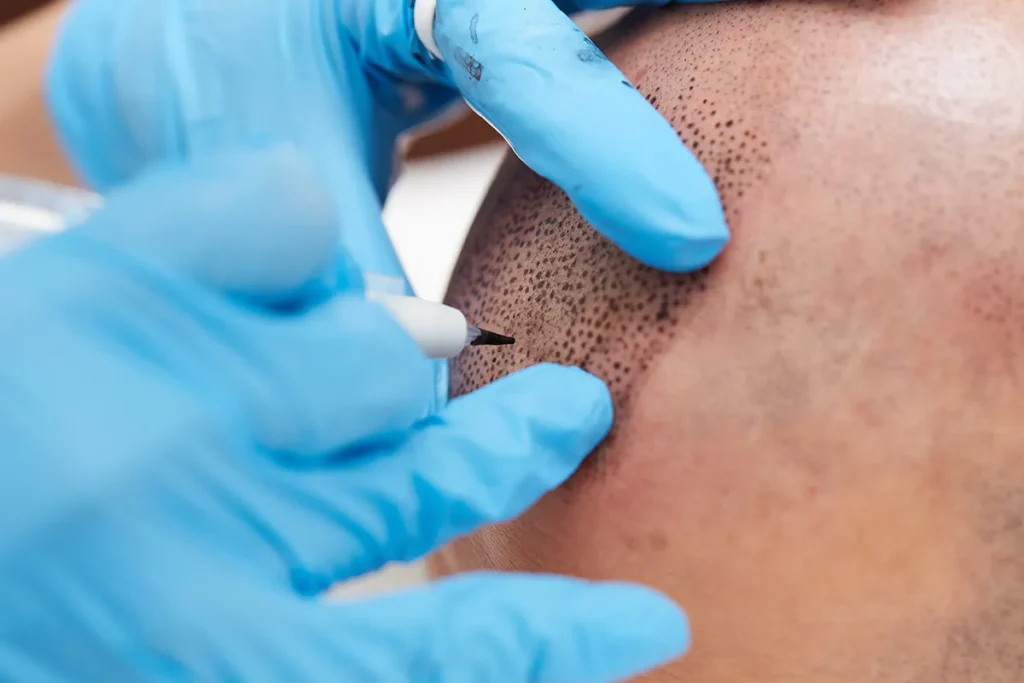 Does Hair Restoration Work? Success Rates & Recovery