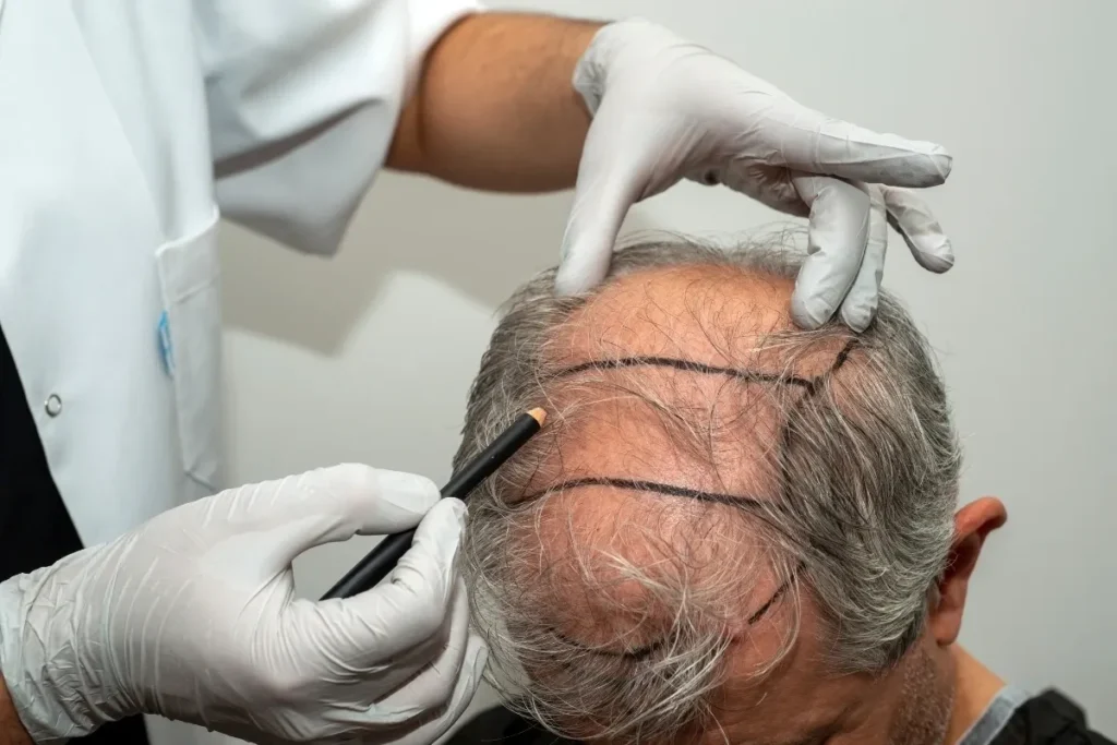 Stress-related hair loss