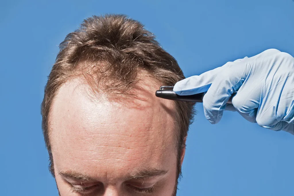 Typical recovery timeline after a hair transplant