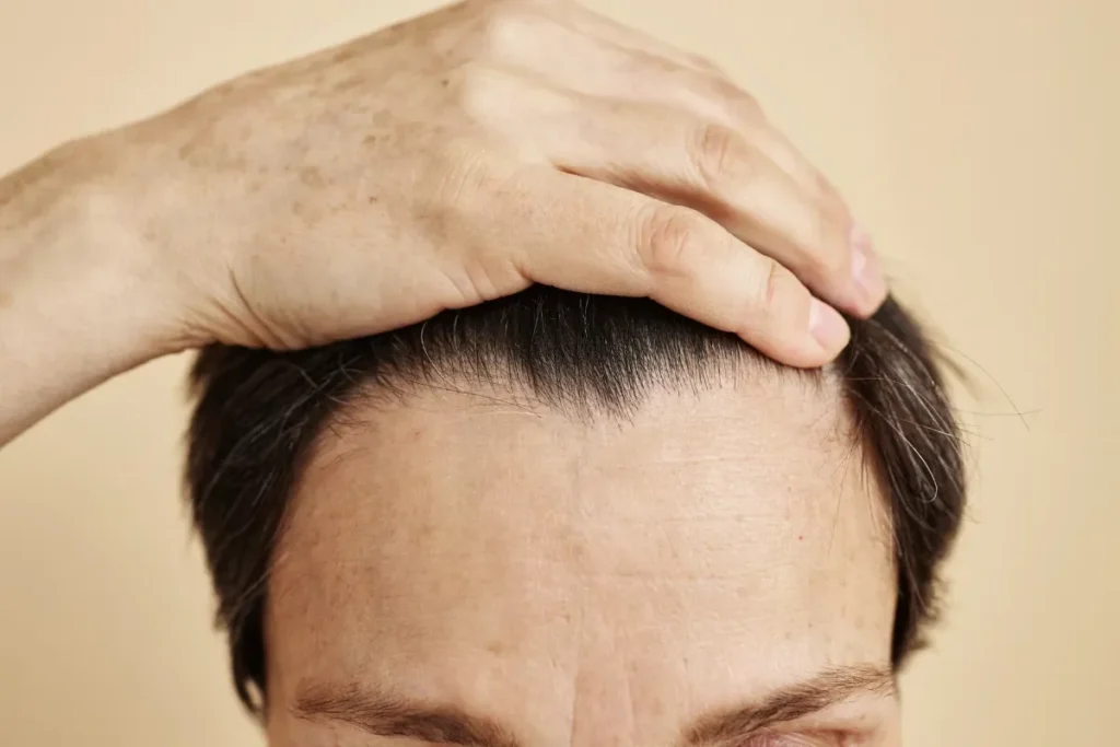 How to Identify a Receding Hairline – Gold City Hair