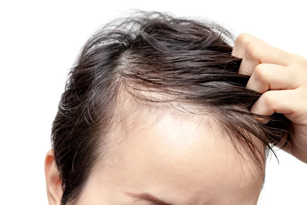 Stem cell preparation for scalp injection