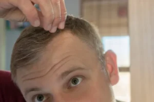Typical results of hairline repair