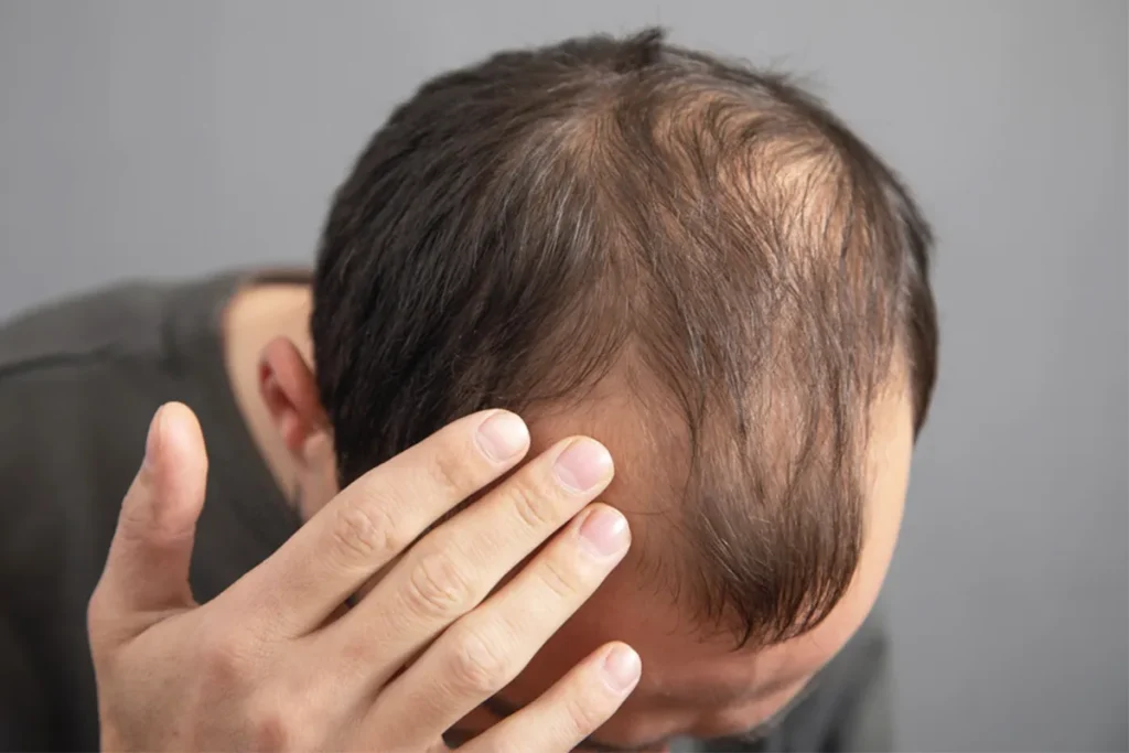 Medical Conditions and Scalp Disorders
