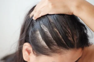 Common Causes of a Sensitive Scalp and Hair Loss