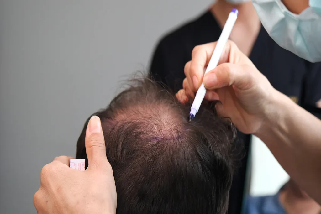 Understanding Excessive Hair Shedding: Causes & Solutions