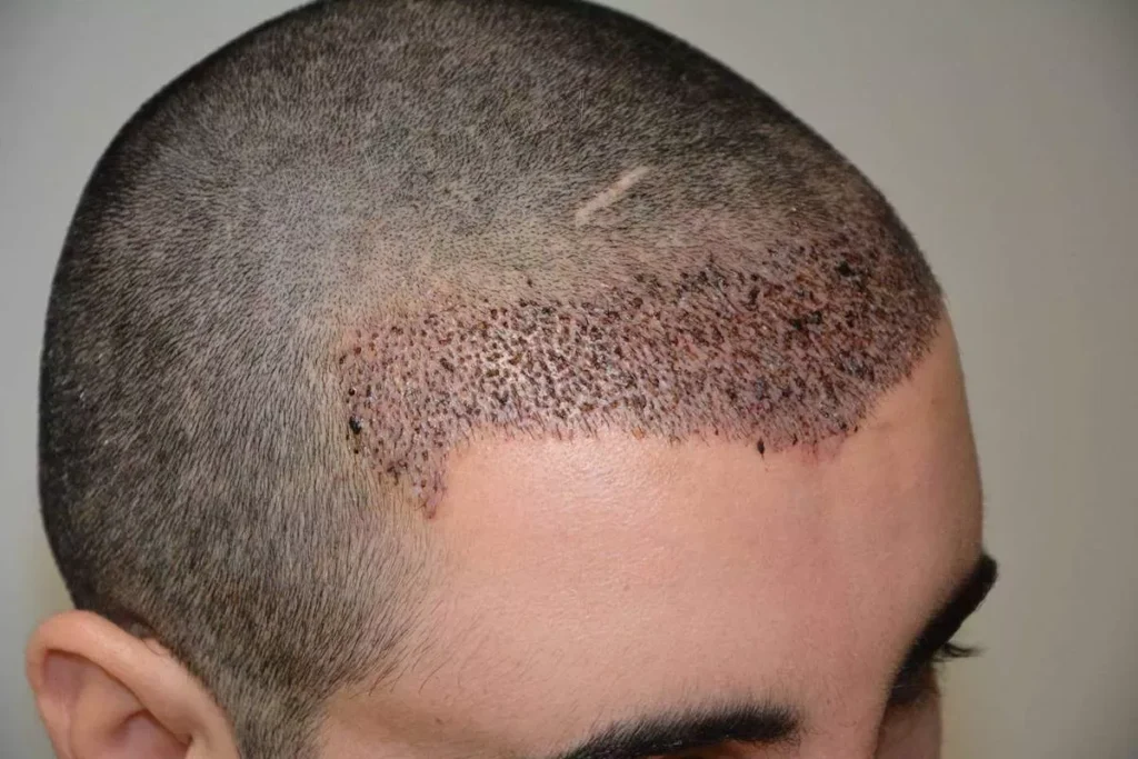 A state‑of‑the‑art clinic prepared for a hair transplant