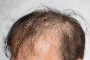Early signs of male baldness often appear in the late teens.