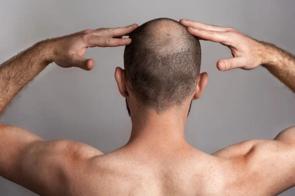 When Do Men Start Losing Hair? Age, Causes & Treatments