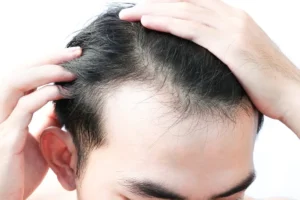 The hair growth cycle showing an increased telogen phase