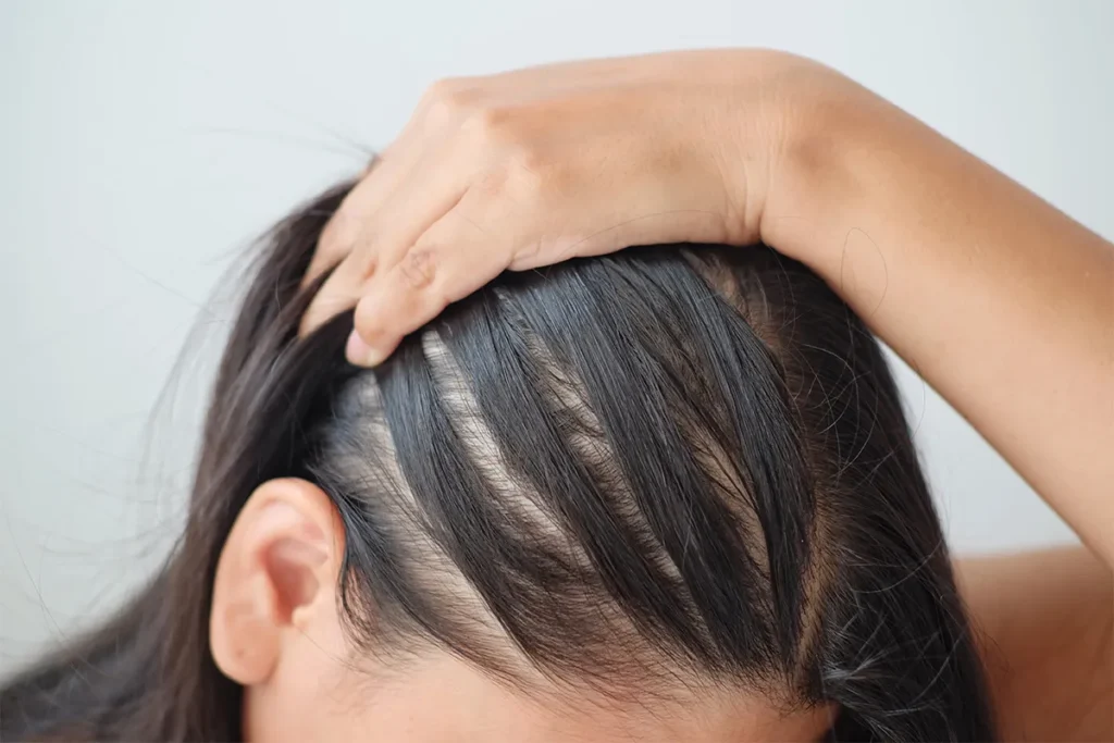 What Causes Front Hair Thinning in Women?